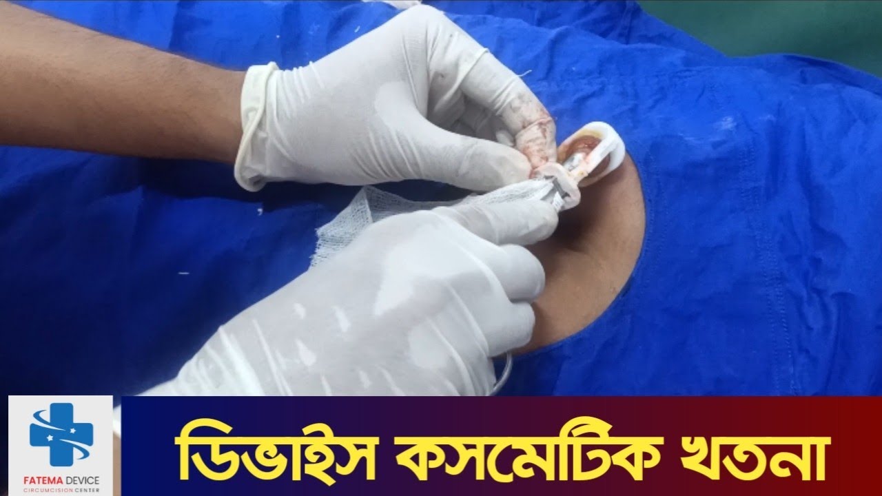 সুন্নতি খৎনা | ডিভাইস কসমেটিক সুন্নতে খাতনা | মুসলমানি | khotna | Mosolmani | Alisklamp circumcision