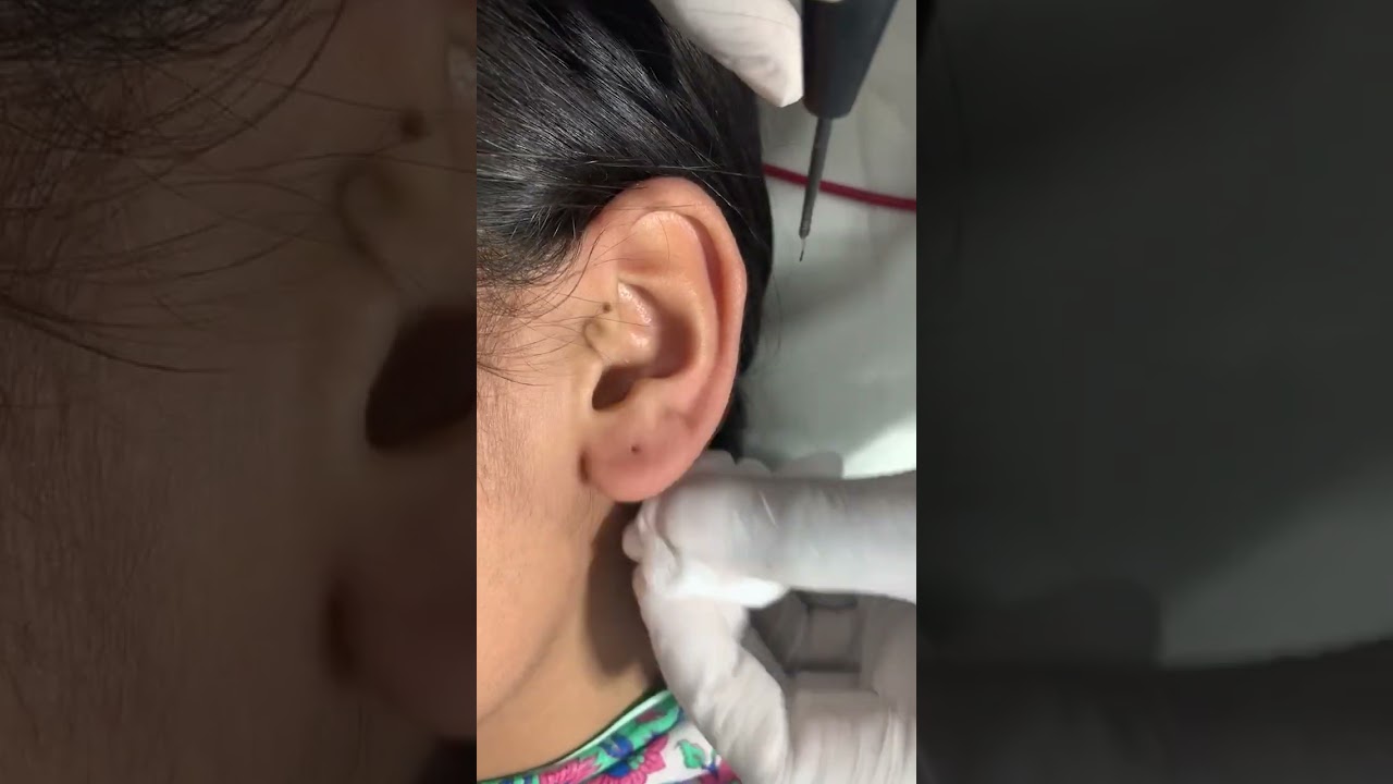 कान में छेद | Ear Piercing without Pain | Painless Earlobes Piercing | Skinaa Clinic #shortsfeed