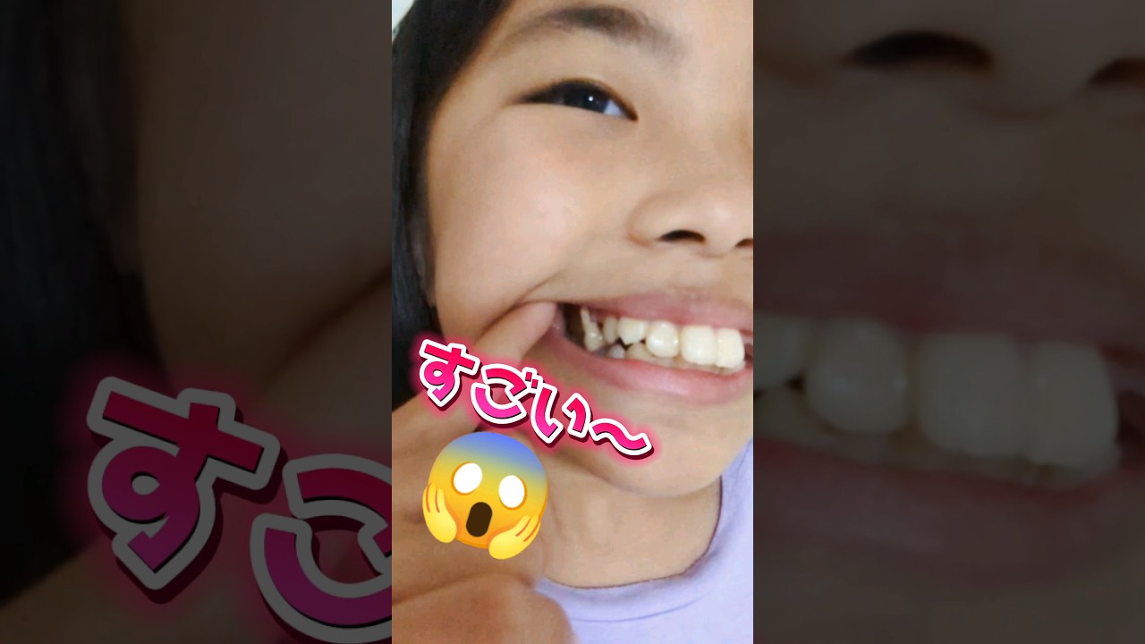 【抜歯】ヤバいぐらいに大きい歯🦷ガブリチュウで抜いてみた😱 #抜歯 #乳歯