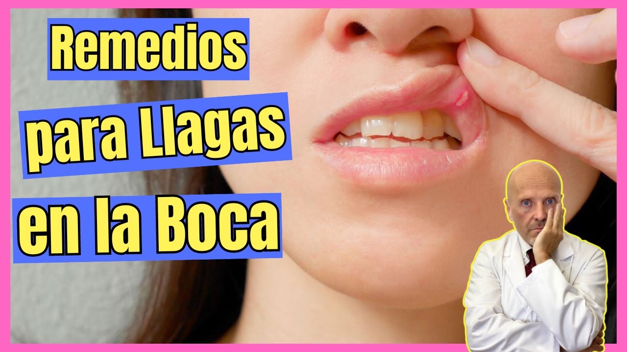 🚨 REMEDIOS CASEROS PARA LLAGAS EN LA BOCA Y LENGUA ¿COMO CURAR UNA LLAGA EN LA BOCA RAPIDO? 🚨