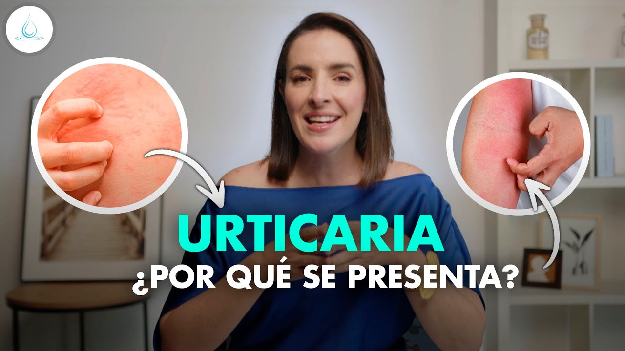 🔴 URTICARIA | Que es? Sintomas y tratamiento! @drapilarochoa - Dermatologa