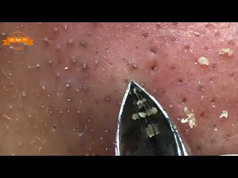 #05 Best Nose Plucking Blackheads Whiteheads Removal | Acne Treatment