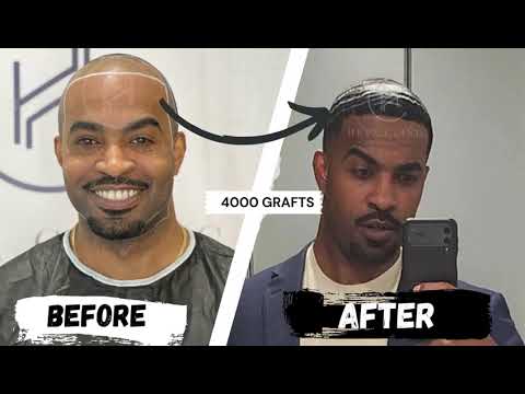 12 MONTHS 4000 GRAFTS AFRO HAIR TRANSPLANT - INSANE RESULT | HEVA #afrohair #hairtransplantturkey