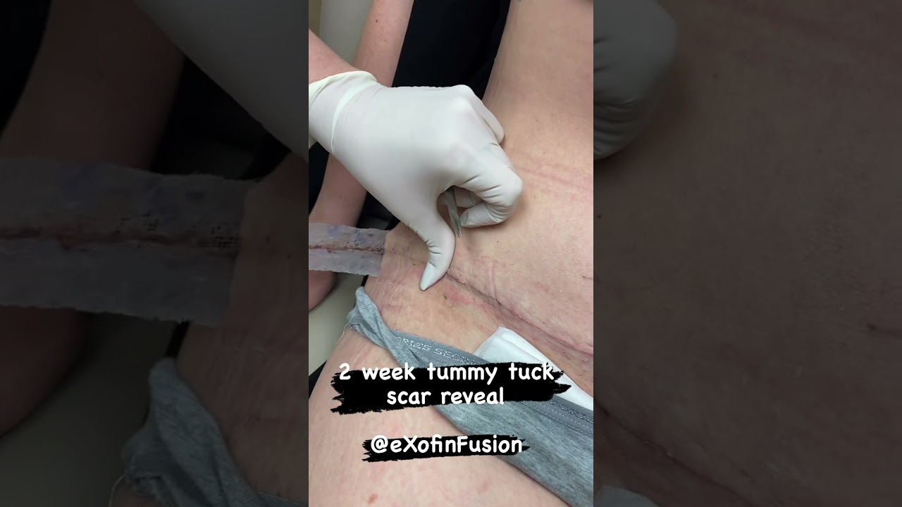 2 week tummy tuck scar reveal
