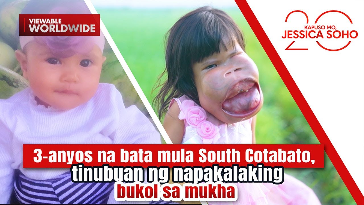 3-anyos na bata, tinubuan ng napakalaking bukol sa mukha | Kapuso Mo, Jessica Soho