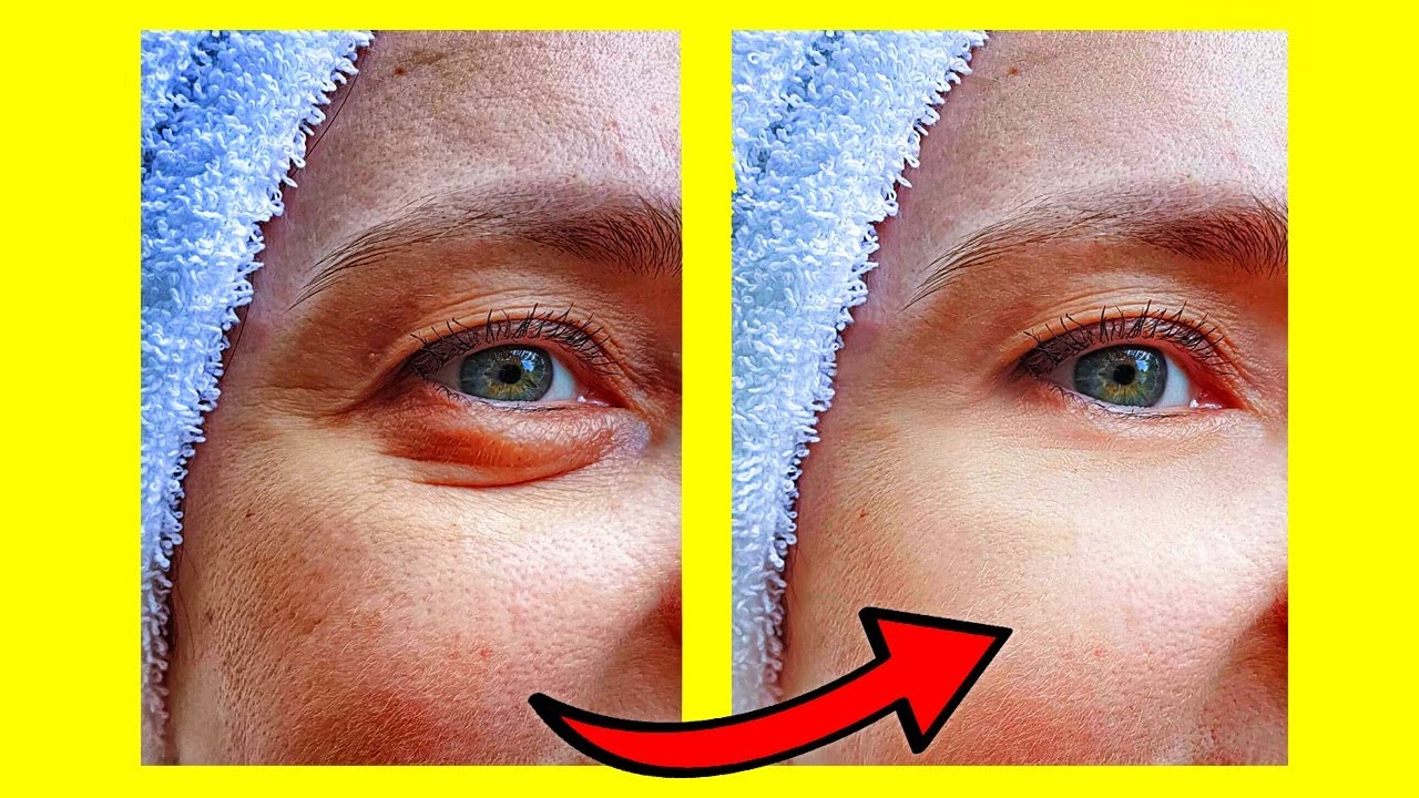 4 Remedios Caseros Para Eliminar Ojeras Y Bolsas Bajo Los Ojos