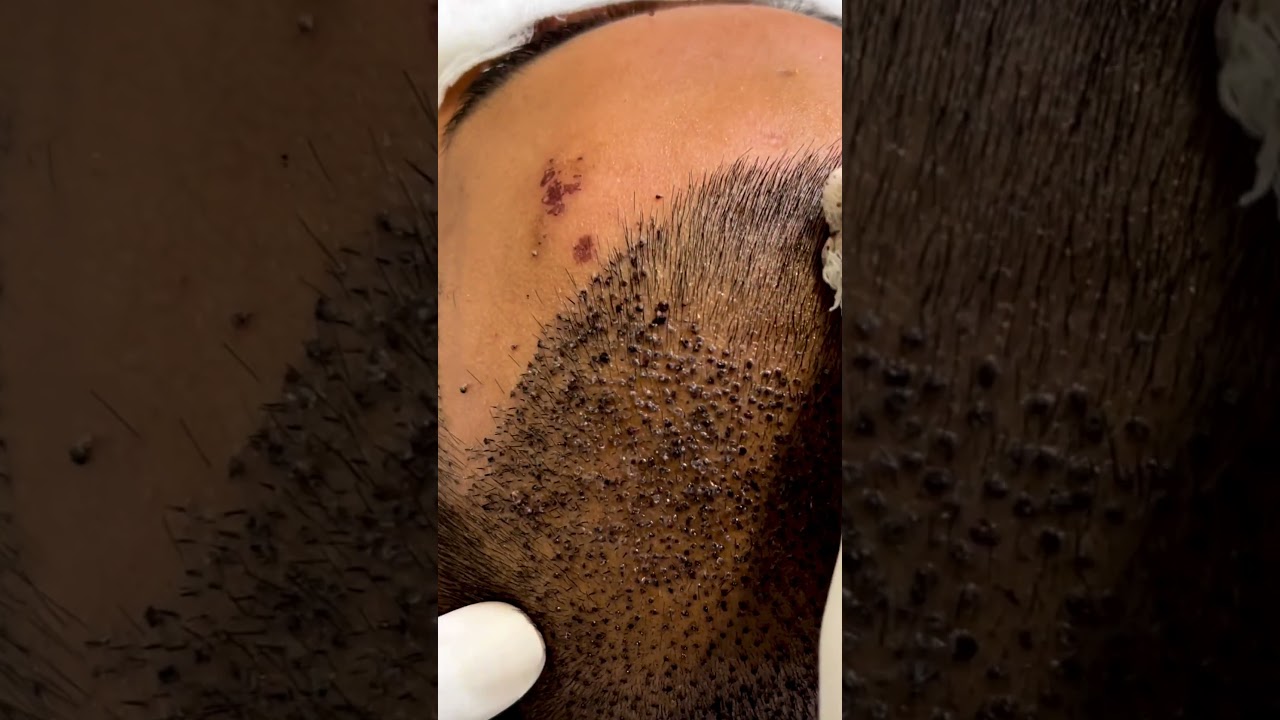 🚀43M+ Views | It’s not just a regular head wash 🚿| Hair Transplant Clinic in Delhi