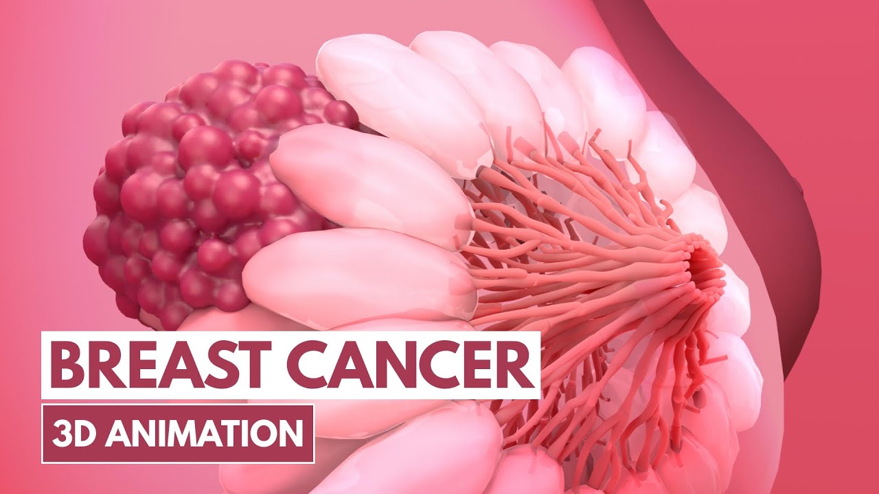 5 Signs of Breast cancer | 3D Animation