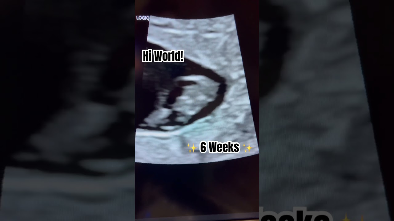 6 weeks pregnant scan #ultrasound