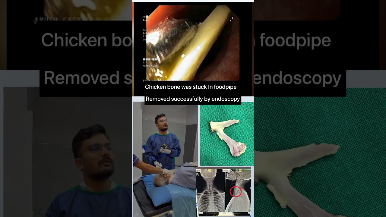 A case swallowed a chicken bone which was stuck in food pipe. Bone was removed by endoscopy!!!