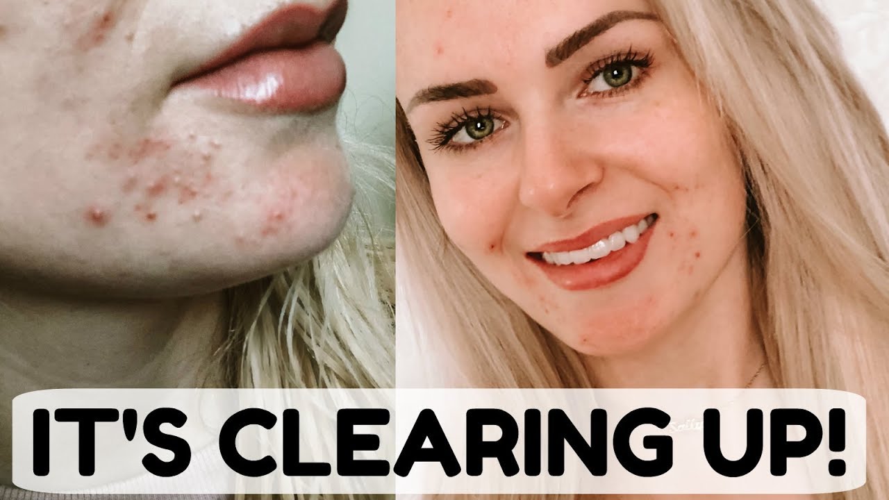 Accutane Month 5 UPDATE + Skin Close Ups