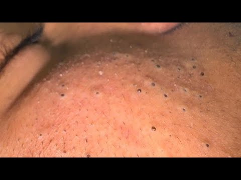 ACNE ANNIHILATOR - Skincare Routine To Treat Pimples By Mai Ngoc