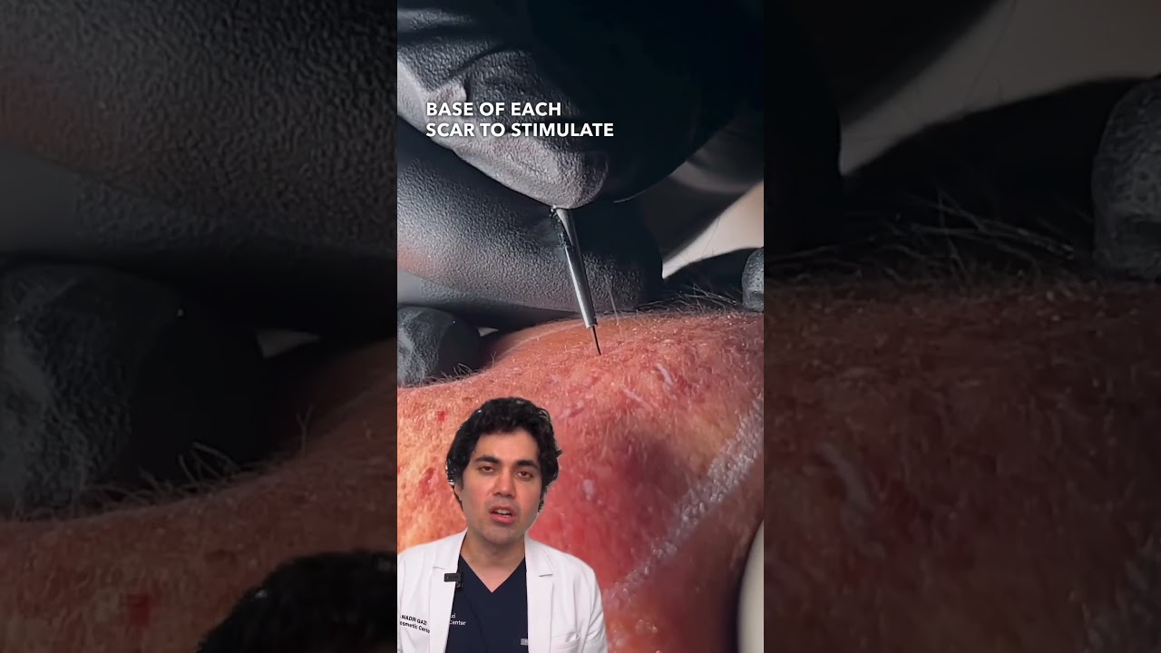 ACNE SCAR SINGLE SESSION Combination Treatment RESULTS 🙌 (TCA, Subcision, Lasers, Fillers)