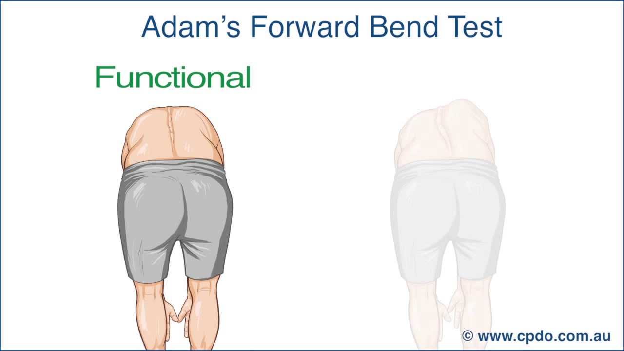 Adam's Forward Bend Test - A Chiropractic Online CE™ Production