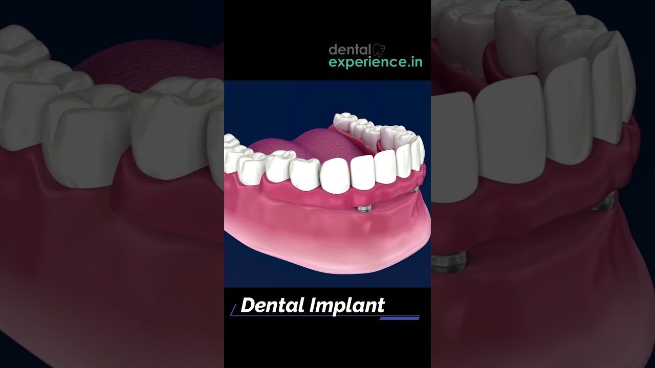 Affordable Full Mouth Dental Implants Cost for Replacing Missing Teeth.