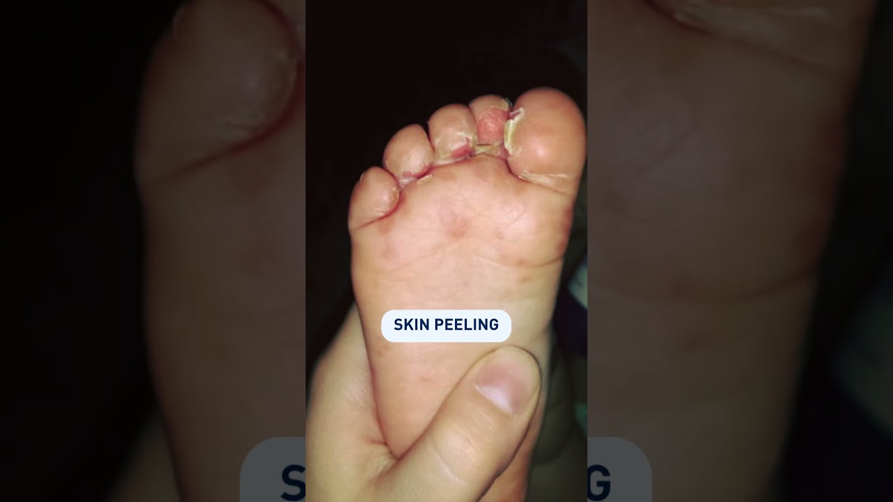 After Hand, Foot & Mouth Disease... #advice #baby #parentalcare #child #handfootmouthdisease