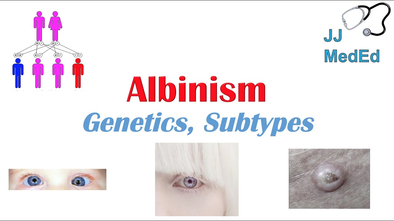 Albinism | Genetics, Different Types, and What You Need to Know