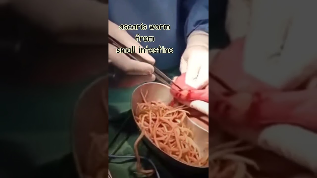 Ascaris worm from small intestine | Tarang academy