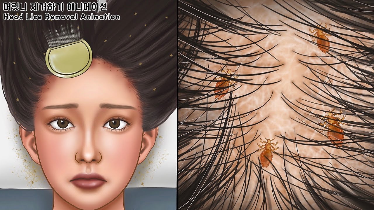 ASMR Creepy! Cool removal of tickled head lice | seborrheic dermatitis treatment