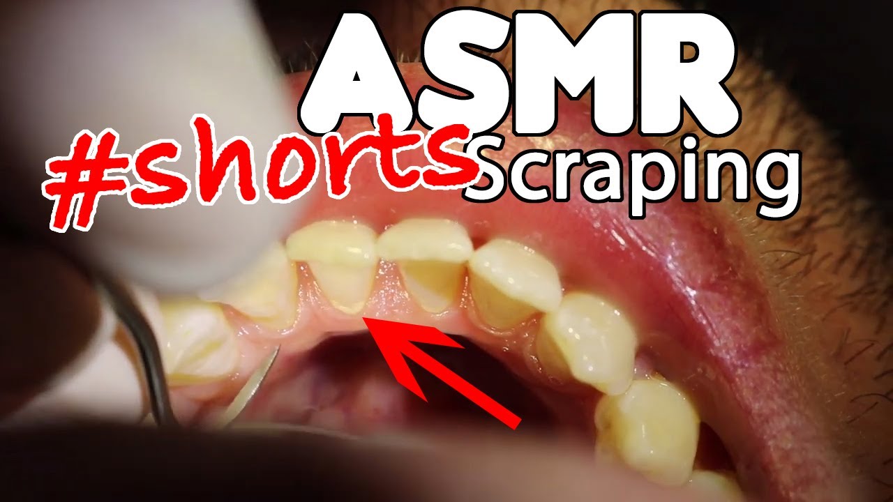 ASMR Dental Scraping Teeth #shorts #teethcleaning #plaqueremoval #plaque