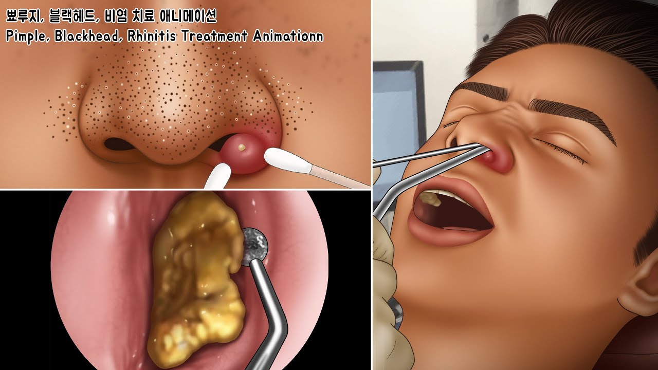 ASMR Nasal Cleaning for Stuffy Nose from Rhinitis & Acne, Blackhead Treatment Animation