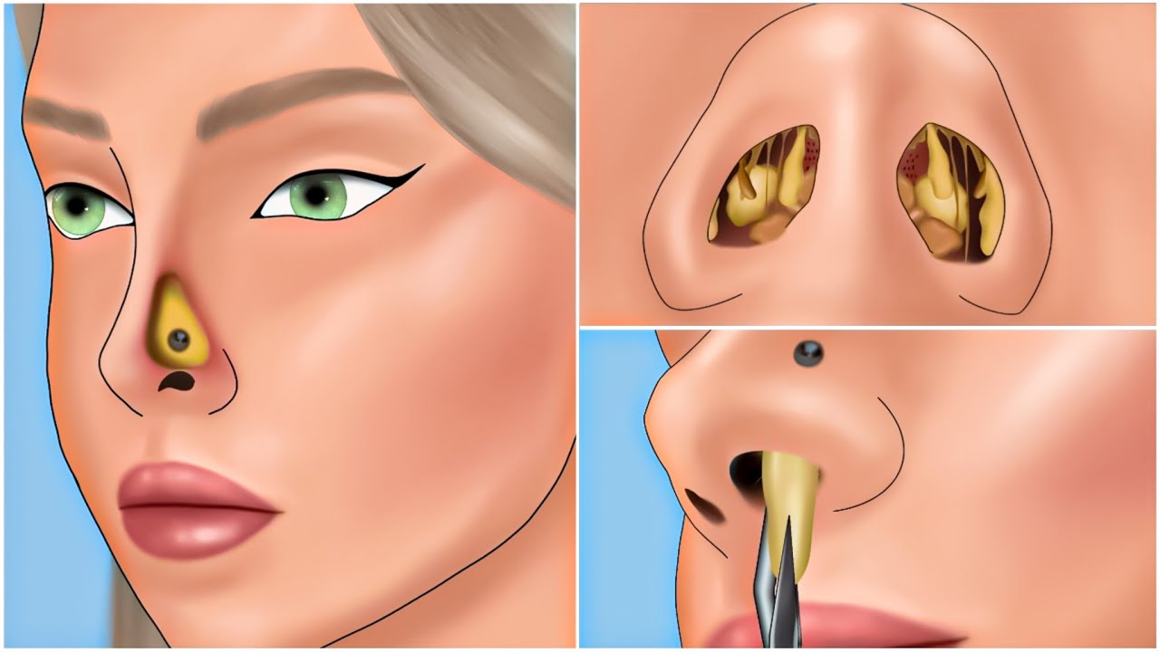 ASMR Nose Mucus Deep Cleaning Animation | Massive Booger and Unmanaged Piercing Removal