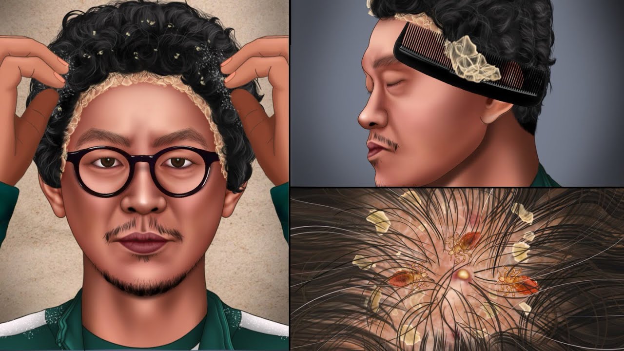ASMR 'Squid Game' Yongsik's Cool Removal of Head LiceㅣTreatment for Irritable Scalp