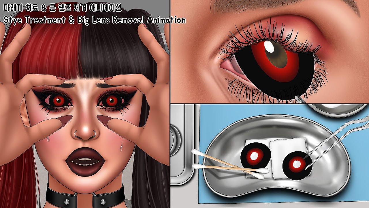 ASMR Why you shouldn’t wear Big lenses carelessly! Big Lens Removal Animation | Stye Treatment