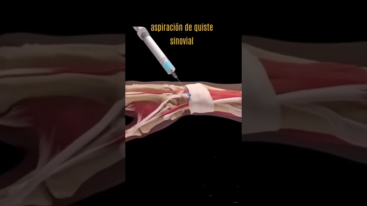 ASPIRACIÓN DE QUISTE SINOVIAL #suscribete #drarmenta #viarsa