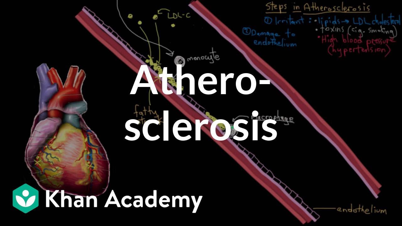 Atherosclerosis | Circulatory System and Disease | NCLEX-RN | Khan Academy