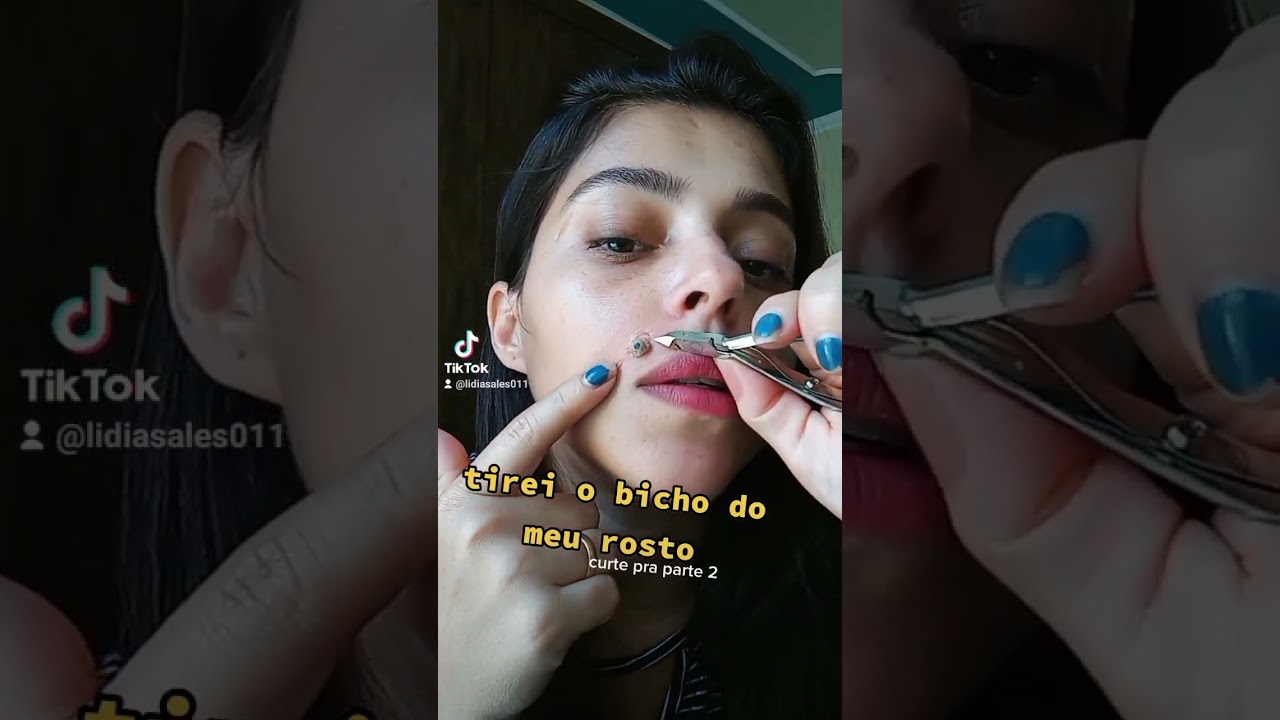 'ATUAÇÃO' TIREI O BICHO DE PE DO ROSTO. #shorts  #short contém ironia