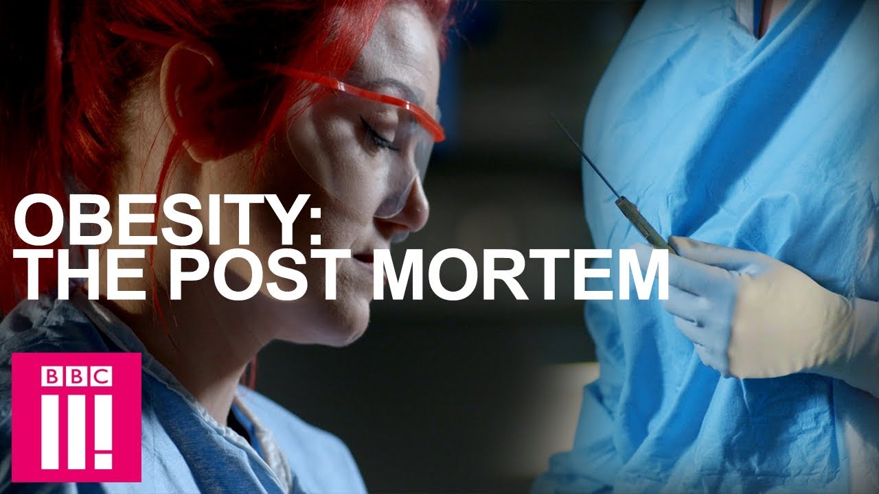 Autopsy On An Obese Woman: Obesity Post-Mortem