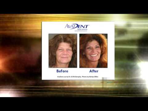 AvaDent Digital Dentures