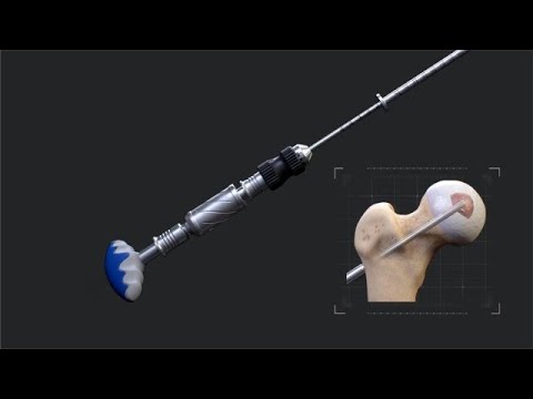 AVN Expandable Reamer