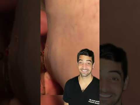 BB removal