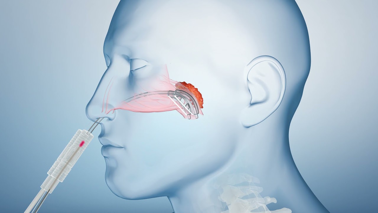 BEBIG Medical: How HDR Brachytherapy/Afterloading works