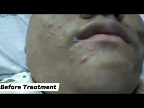 Before Acne Facial