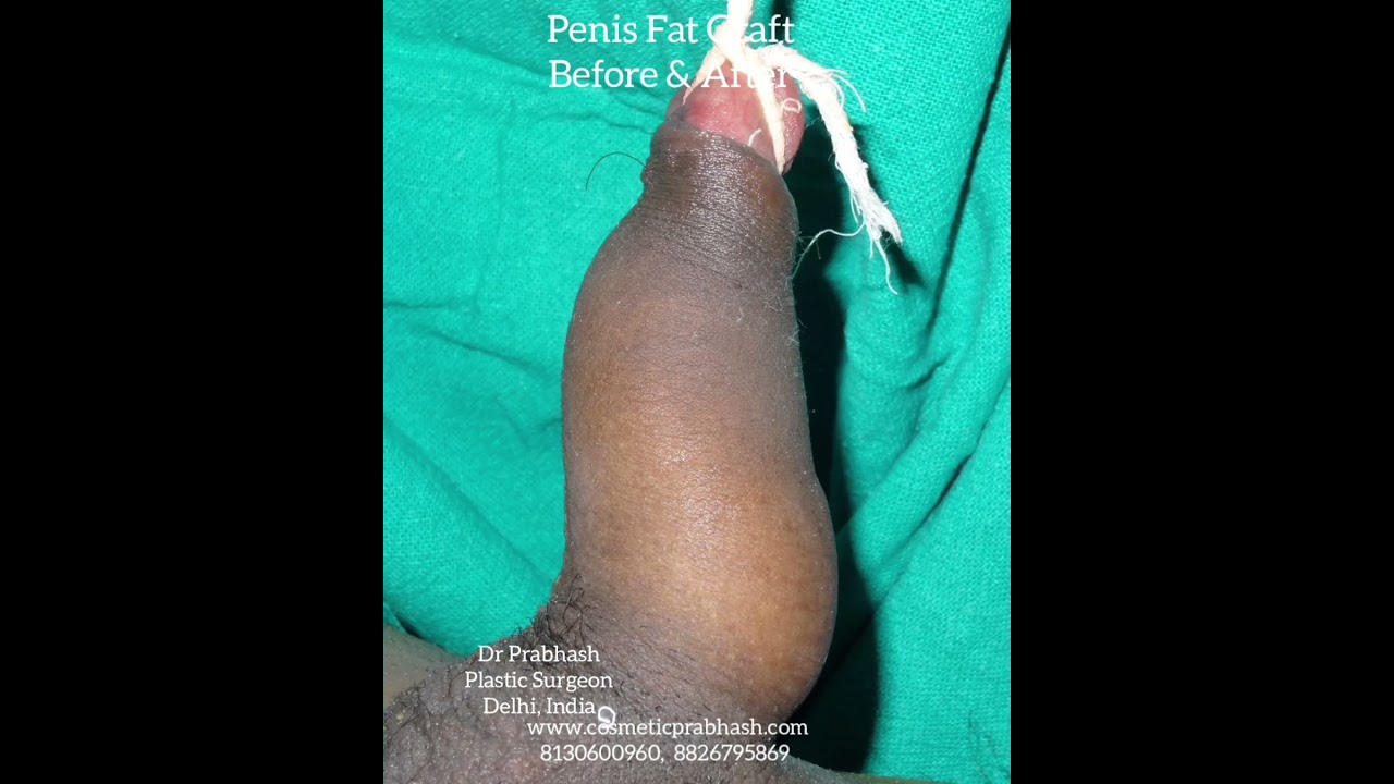 Best Big Penis Enlargement in India, Delhi by Dr Prabhash Before After Pictures