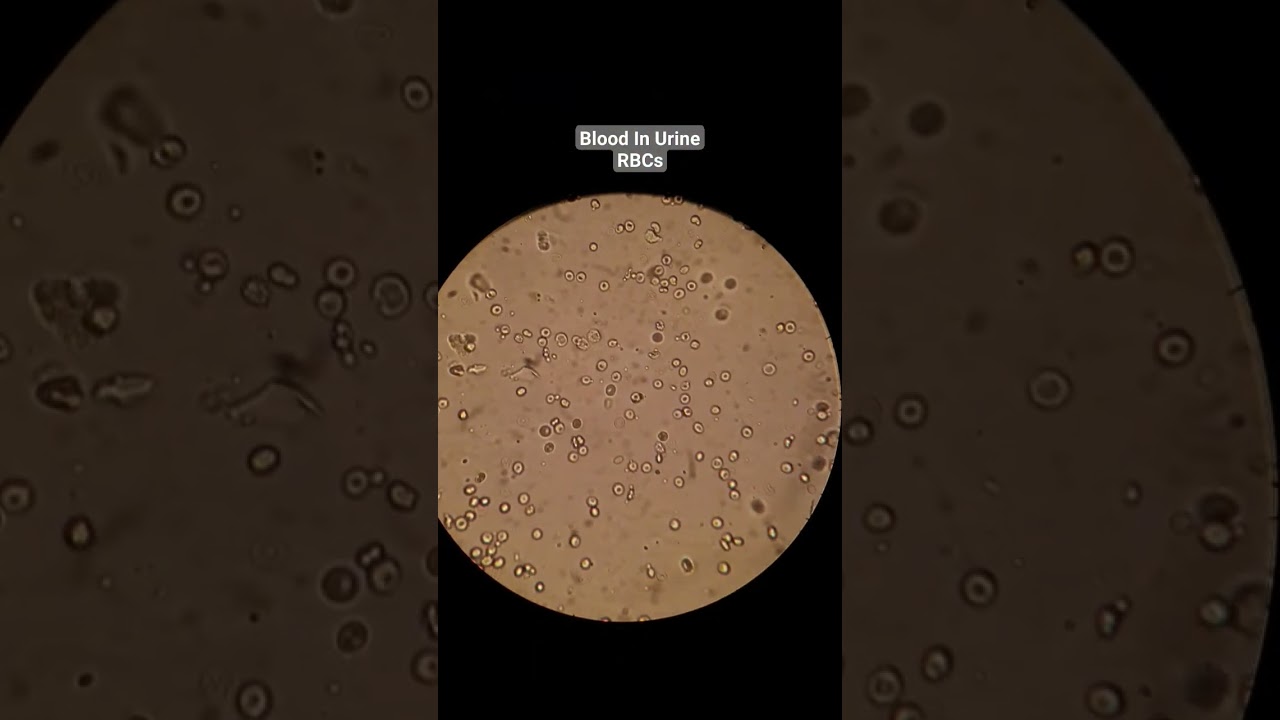 Blood in Urine | Urine Routine Examination | Microscopic examination
