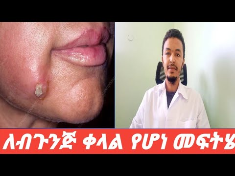 ብጉንጅ(boil)   #ማያ_ትዩብ(maya tube)