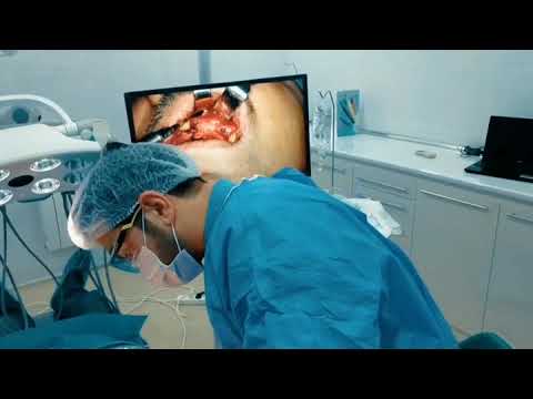 Bone Augmentation surgery. Sumuk kocurulmesi emeliyyati