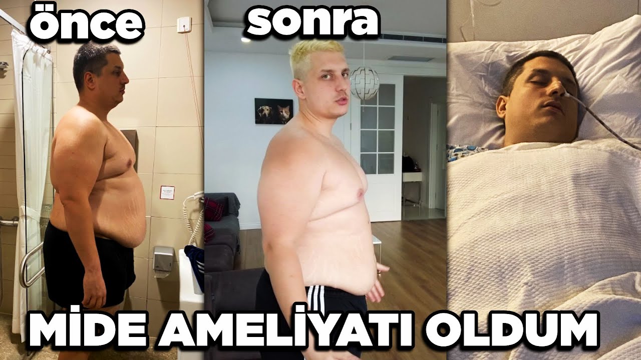 BİR BUÇUK AYLIK DEĞİŞİM | MİDE AMELİYATI ÖNCESİ VE SONRASI YAŞADIKLARIM LEVO & BAHAR VLOG