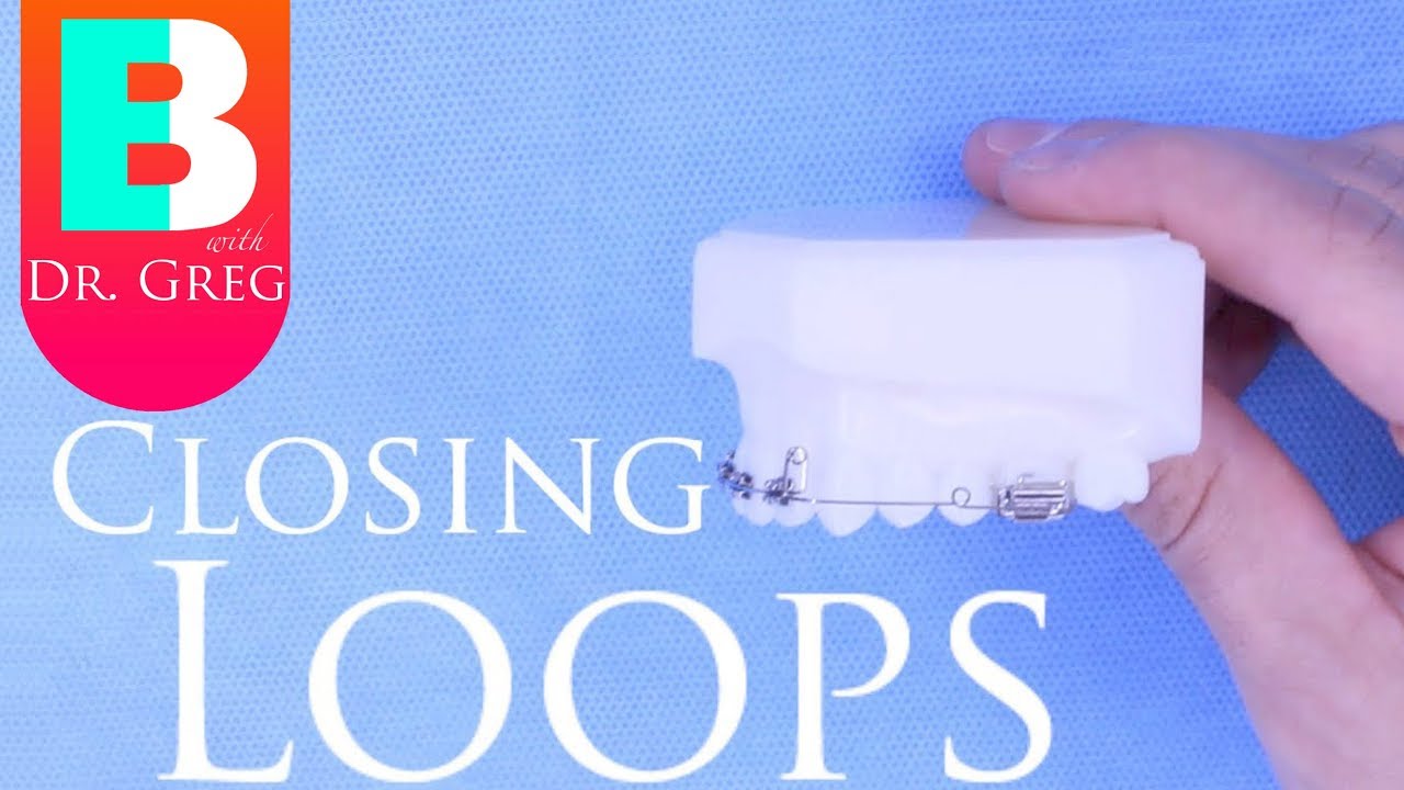 [BRACES EXPLAINED] Closing Loops
