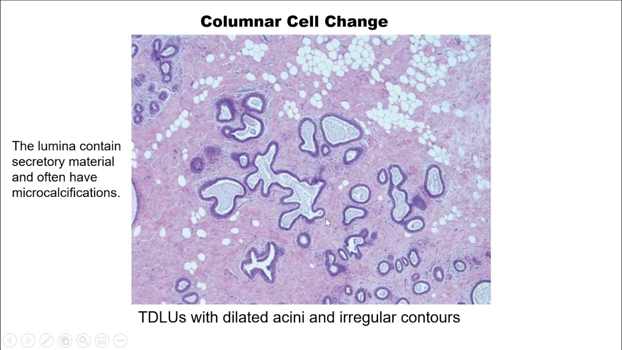 Breast Pathology Case 1