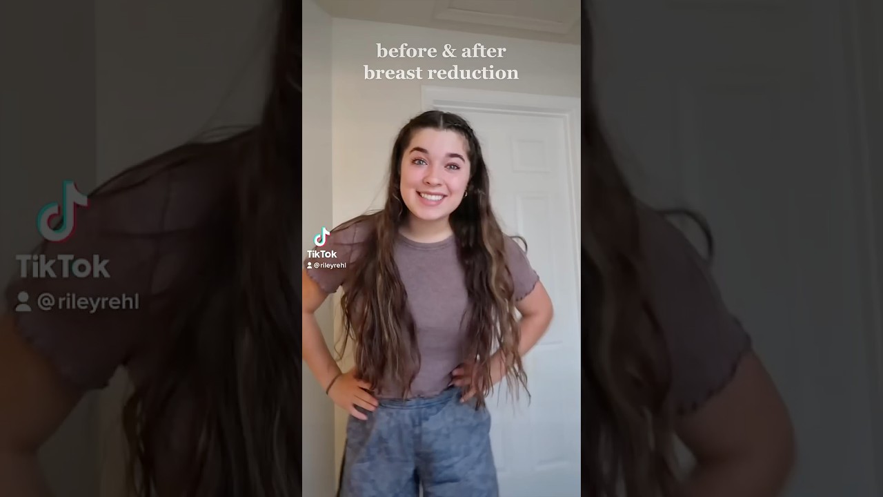 breast reduction before & after! feeling grateful 🥹🫶🏻