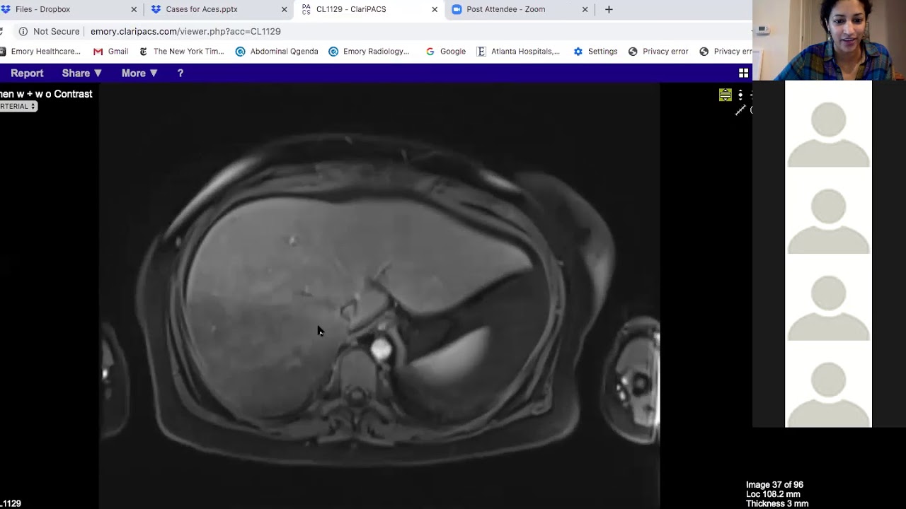 Budd Chiari, hepatic infarct, or steatosis?  Dr. Aarti Sekhar
