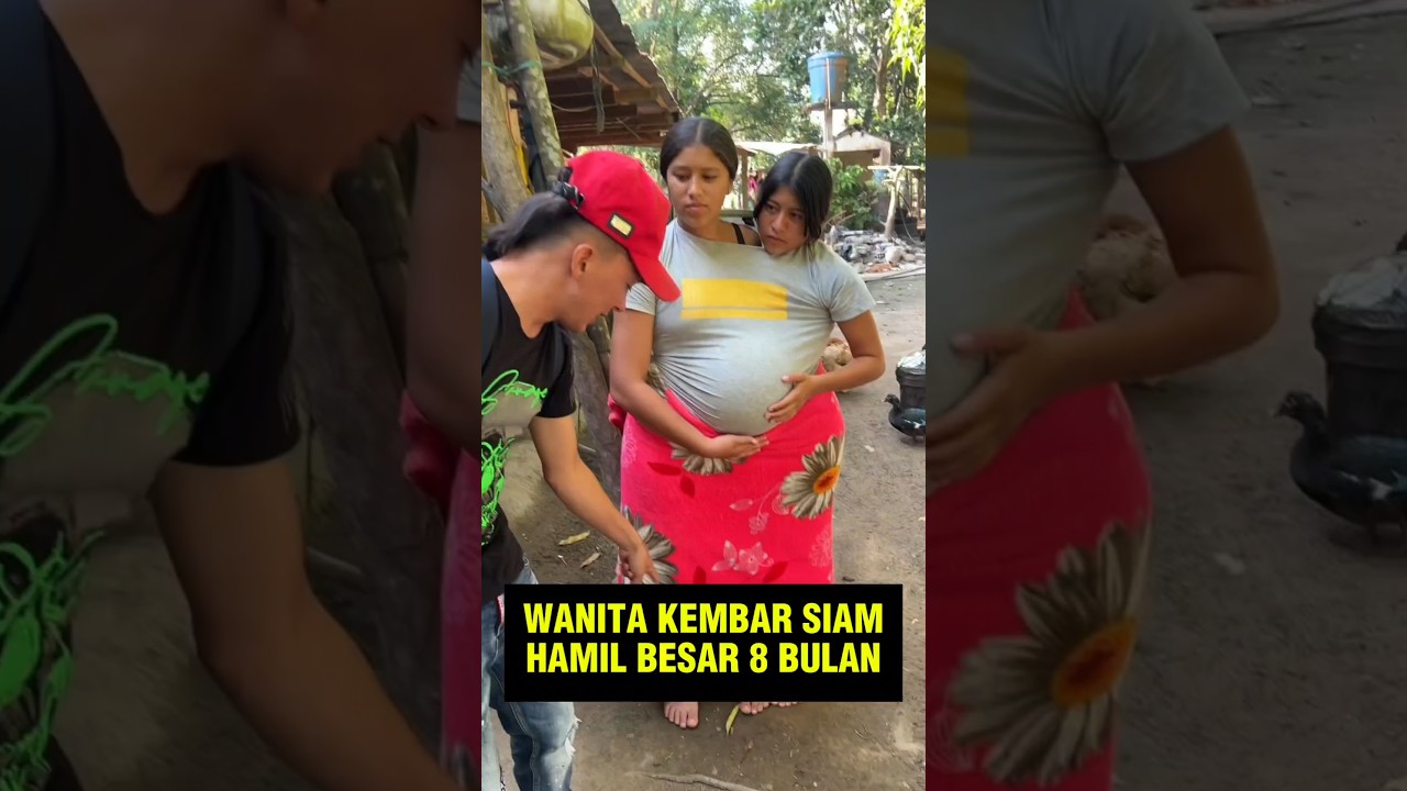 Bumil Kembar Siam Hamil Besar 8 bulan