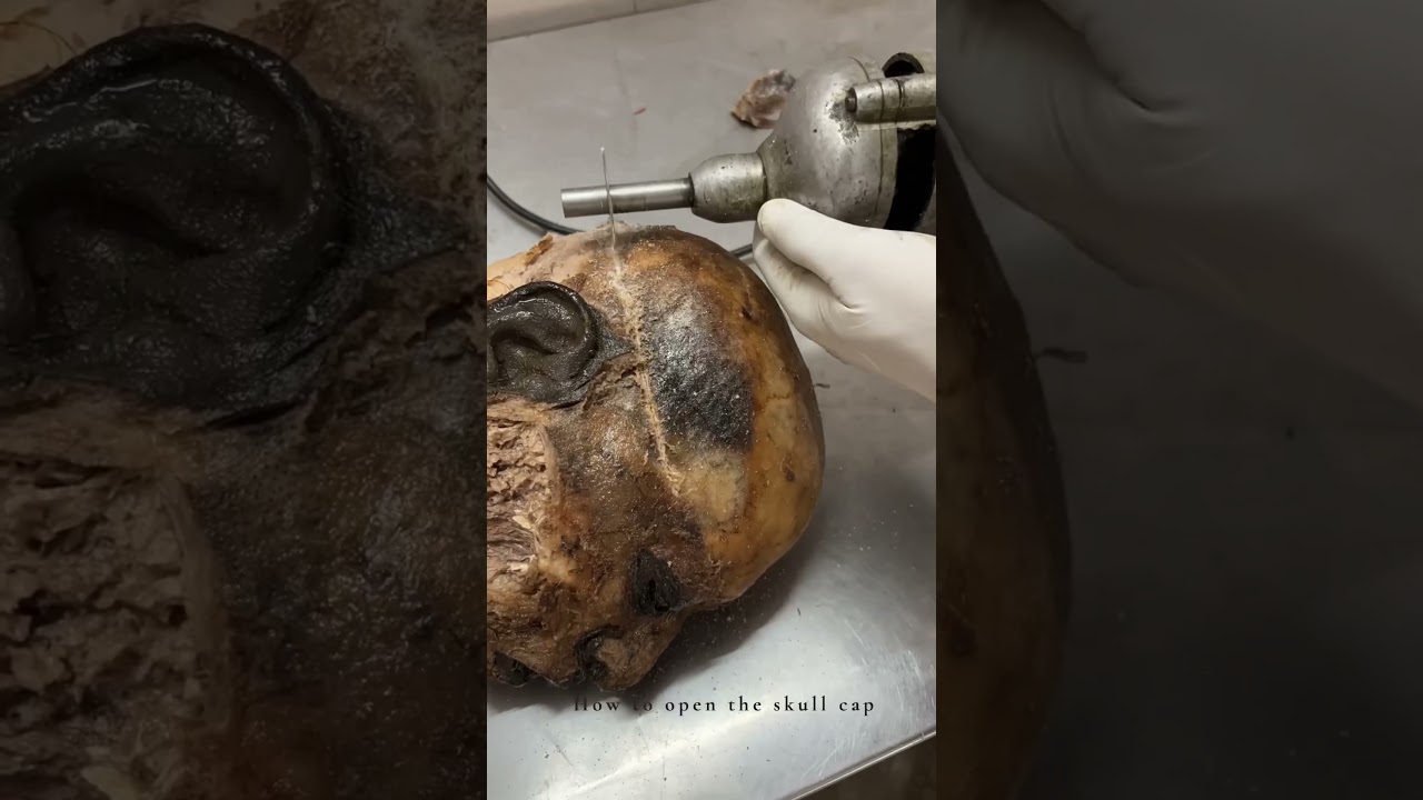 Cadaveric Dissection of skull : For teaching Anatomy