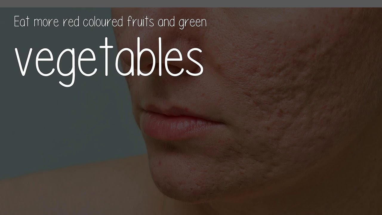 Can Kenacomb Work For Acne?