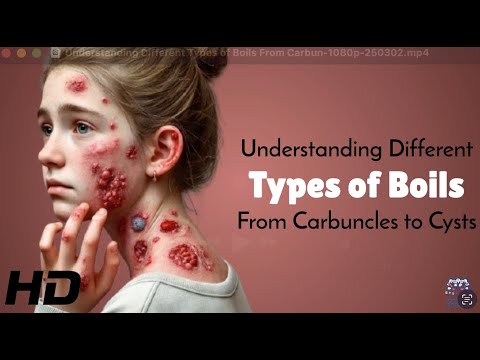 Carbuncles, Cysts & More: Understanding Different Types of Boils